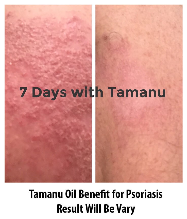 Tamanu Oil for Psoriasis