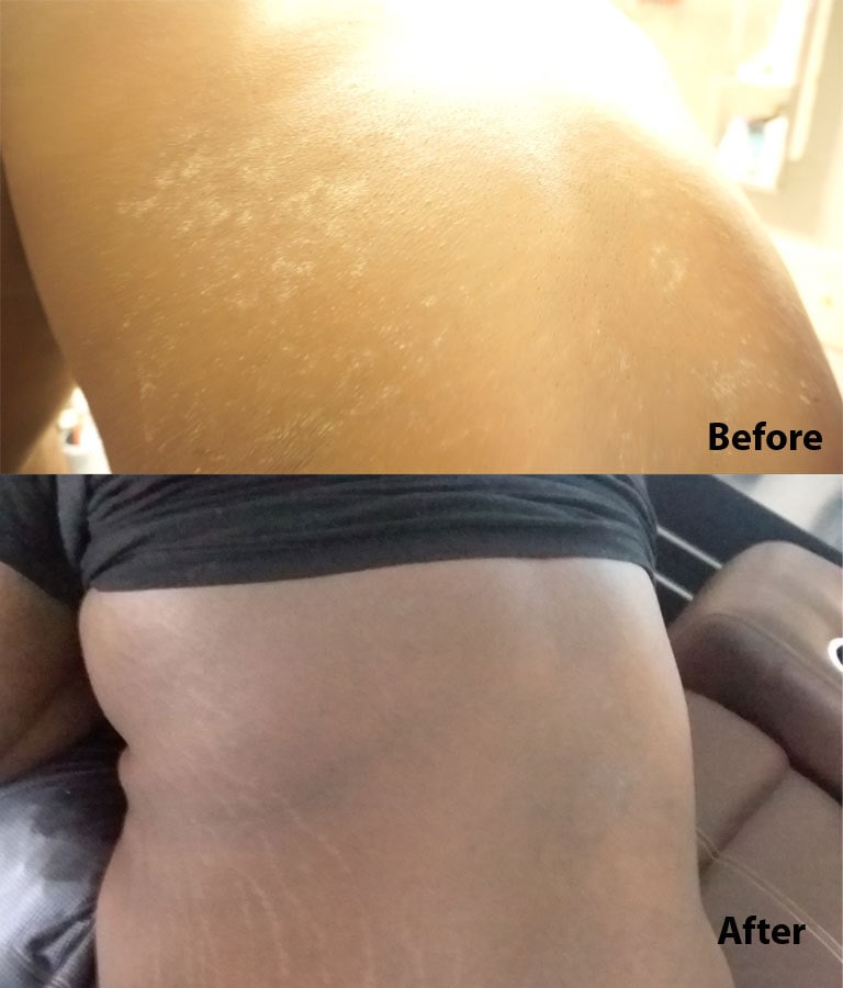 Eczema-Back-Before-After-Tamanu-Oil