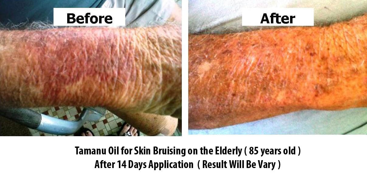 Tamanu-Oil-for-Skin-bruising-in-the-elderly-2